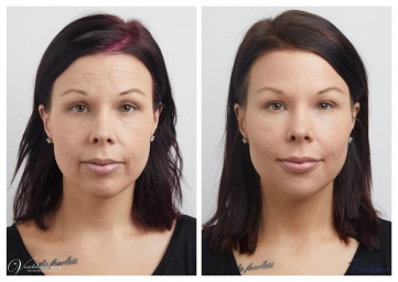 Före och efterbilder på behandling av hela ansiktet med filler på Vendelakliniken