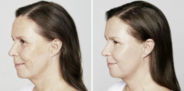 Restylane Skinbooster före och efter behandling på Vendelakliniken