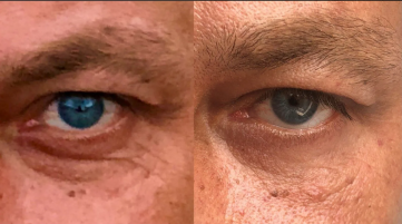 Sunekos förebygger och minskar tecken på åldrande runt ögonen