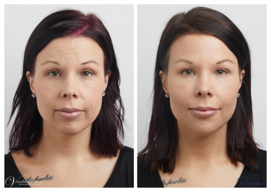 Före och efter: botox full face