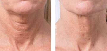 Profhilo är en perfekt behandling för att strama upp huden på halsen.