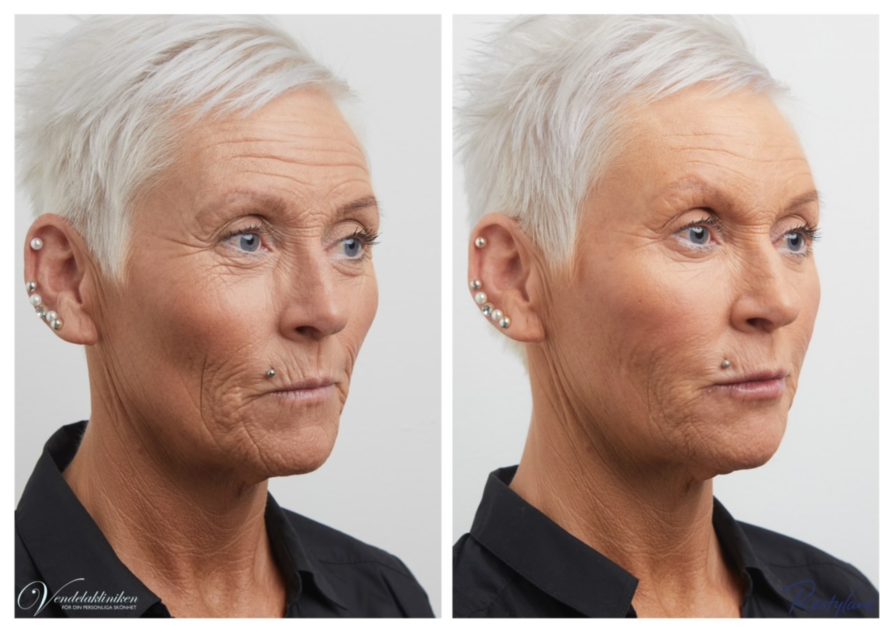 Före och efter: Botoxbehandling hela ansiktet