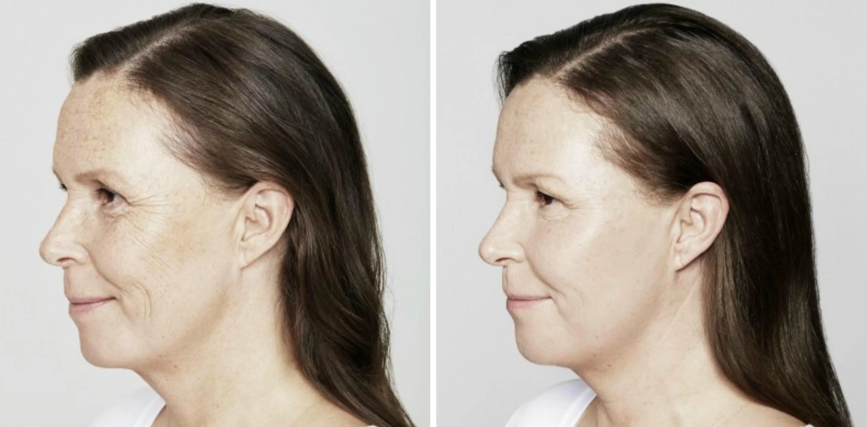 Restylane Skinbooster före och efter behandling på Vendelakliniken